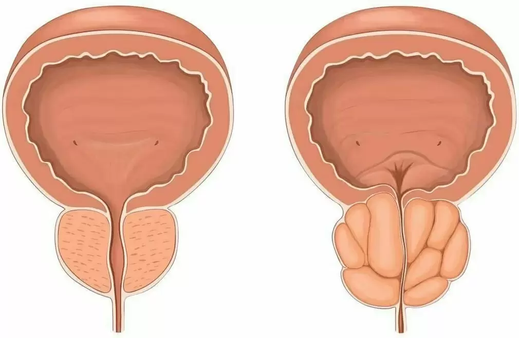normální prostata a nemocná prostata